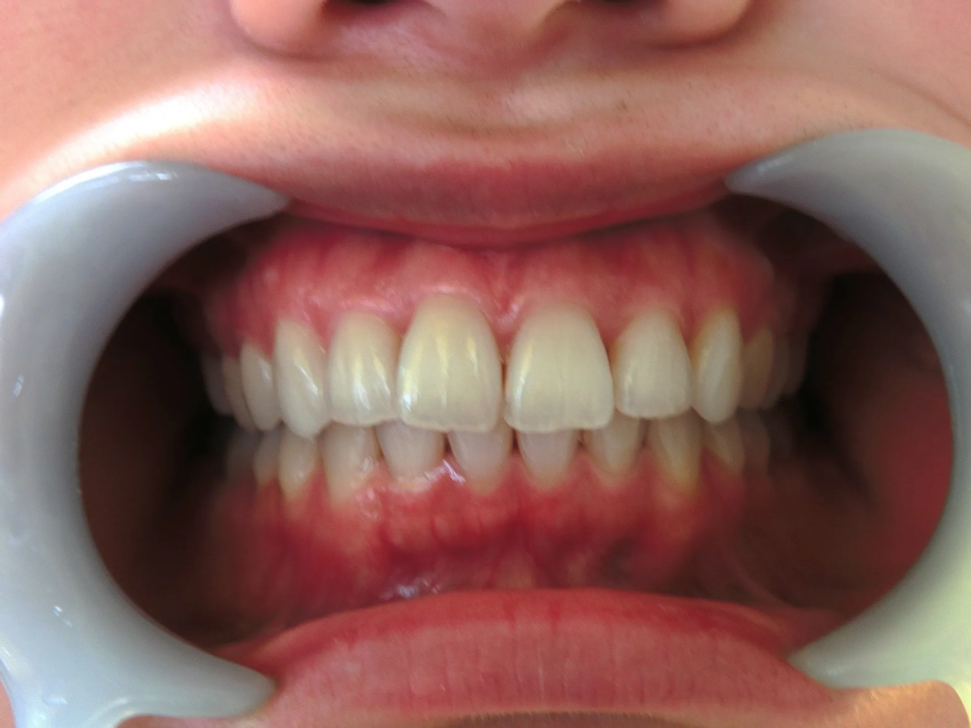 芸能人は歯が命とかなんとか。