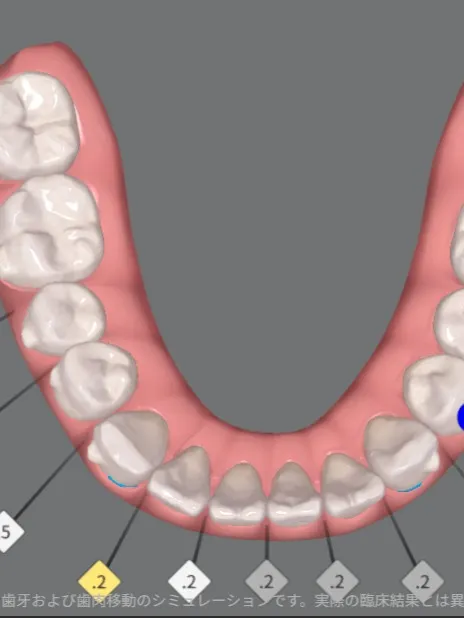 歯を抜かずに矯正!こんにちは!神戸元町 玉川歯科医院です🙂