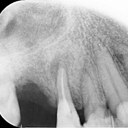 ラバーダムでの根管治療は基本!神戸元町 玉川歯科医院です🙂