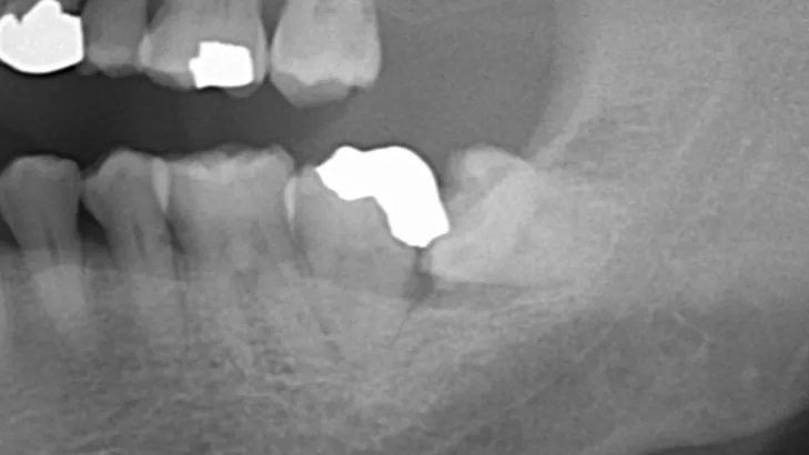 抜歯についてご紹介！神戸元町　玉川歯科医院です🙂