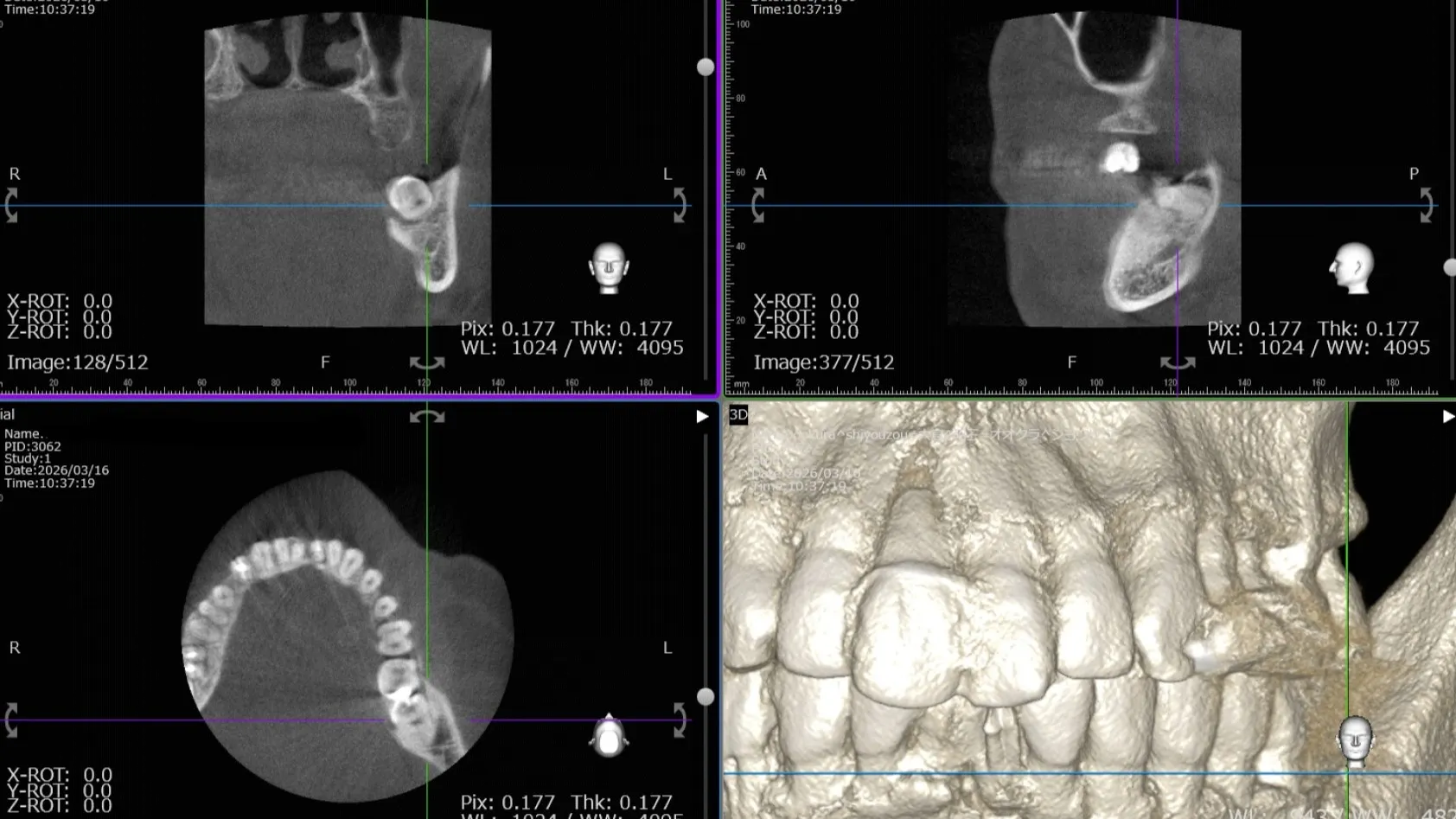 抜歯についてご紹介！神戸元町　玉川歯科医院です🙂